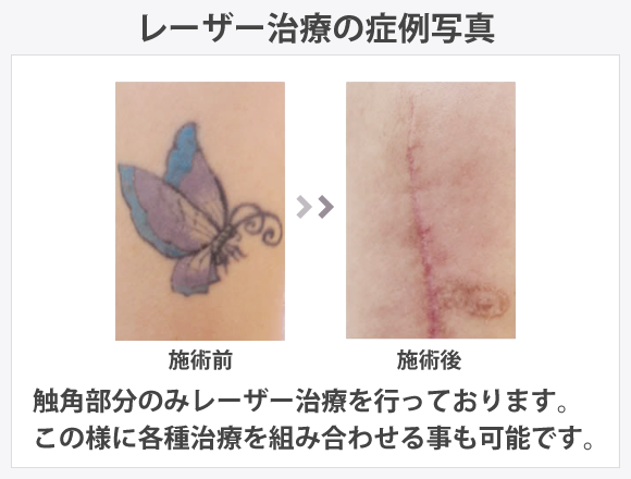 切除による方法