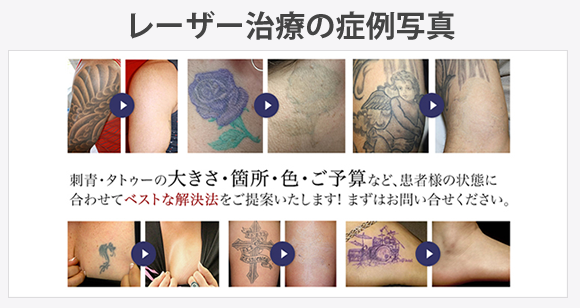 レーザー治療法