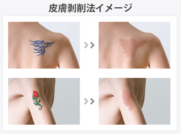 切除による方法